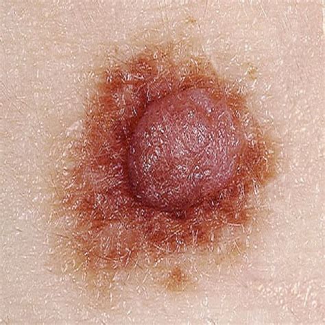Got a call today that all of my blood work except for the tumor marker was normal. Mole Suddenly Raises! Is It Serious? | Med-Health.net