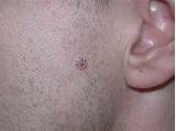 Skin has several layers, but the two main layers are the epidermis (upper or outer layer) and the dermis (lower or inner layer). Basal cell carcinoma (BCC) - ACD