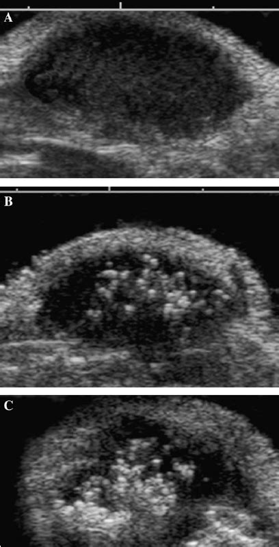 It can help your healthcare provider find breast problems. B-mode ultrasound images of MDA MB231 human breast cancer ...