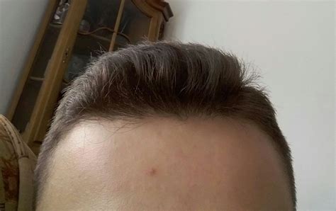 Haarausfall beschreibt den verlust von übermäßig vielen haaren. Ist das Haarausfall/hilfeeeeeee? (Gesundheit, Haare)