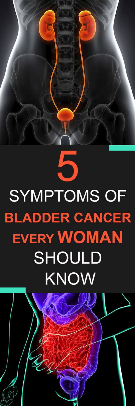 Urine cytology and/or tumor markers: 5 Symptoms of Bladder Cancer Every Woman Should Know