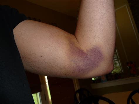 Numbness in the wrist, hands, fingers, or elbow. The Bicep Injury