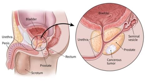 Interactive section of medindia defines prostate gland location. Prostate Cancer - Immortal News