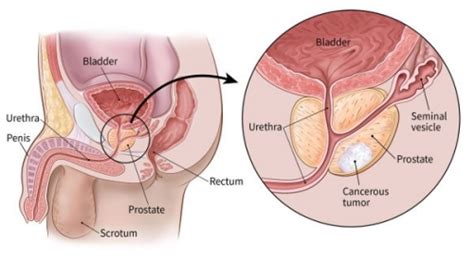 The tumor will narrow the duct and the urine flow will diminish. Four In Ten Prostate Cancer Cases Are Diagnosed Too Late ...