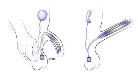 A vasectomia em si consiste isso acontece em função do processo de fibrose (formação de cicatriz) que ocorre ao longo dos anos, podendo criar obstruções nos canais, logo. Prótese Peniana - Dr. Marcelo Thiel