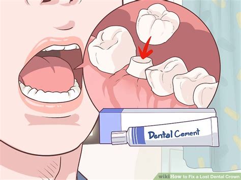 This technique actually (and completely) fixes loose teeth together by crowning the affected teeth and making a splint in which. How to Fix a Lost Dental Crown: 15 Steps (with Pictures ...