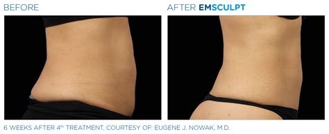 Jan marini offers medically advanced skin care that provides solutions for visible signs of damage, aging and various skin conditions. Emsculpt_PIC_Ba-card-female-abdomen-103_ENUS100 | Blue ...