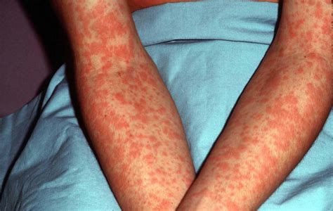 Amoxicillin rash is more common in children with girls being more likely to develop one than boys. Mononucleosis Causes, Symptoms, Diagnosis, Test & Treatment