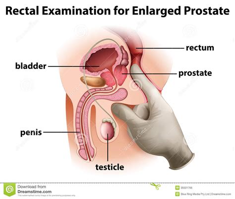 The left lateral position may be uncomfortable for elderly patients. Rectal Examination For Enlarged Prostate Stock Vector ...