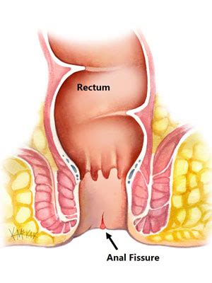 After that, anything can happen. Anal Fissure - FV Hospital