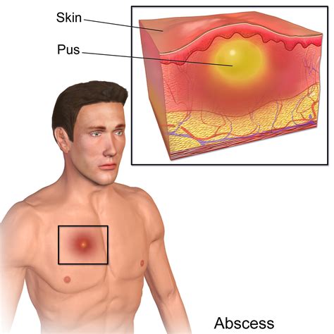 I saw a diagram of groin glands and i didn't understand anything. Гнойни процеси (абсцес, цирей) - Вербена М