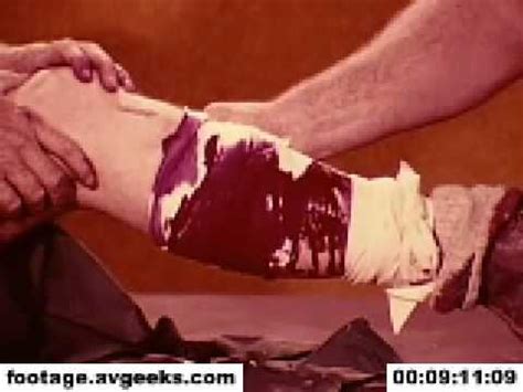 How to stop a small cut from bleeding? 1970s stock footage - control of bleeding 2 - YouTube