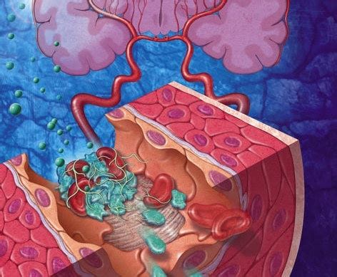 Die behandlung von schlaganfällen könnte sich bald deutlich. Neue Entwicklungen in der Schlaganfall-Therapie - Der Hausarzt