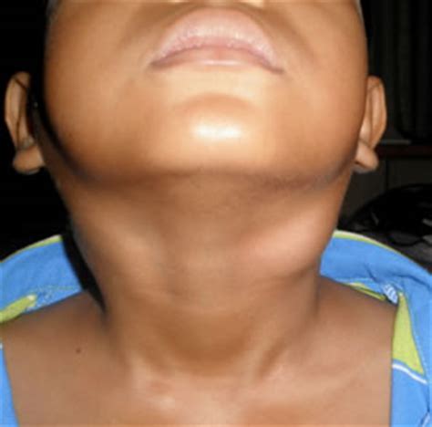Swollen lymph nodes may signal an infection. Malaysian Family Physicians - A child with epistaxis ...