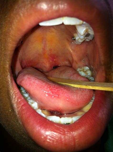 Hereditary angioedema (hae) is a disease characterized by recurrent episodes of angioedema,withouturticaria or pruritus, which most often affect the skin or muc. Critical upper airway obstruction in sporadic angioedema responding to C1-esterase inhibitor ...