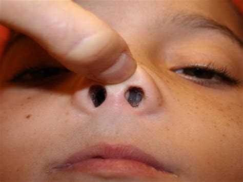 They typically form in clusters. Nasal Polyps in Children |authorSTREAM