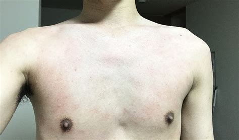 優れた 温熱 蕁 麻疹 顔 - すべての人気の壁紙