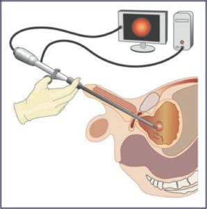 Sous anesthésie locale, on injecte du sérum physiologique puis on aspire le liquide injecté dont la. Groupe Urologie : Fibroscopie Urétro-vésicale ou urétro ...