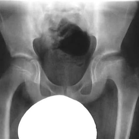 Note that the femoral head is completely contained inside the hip cup. Perthes disease | Eurorad