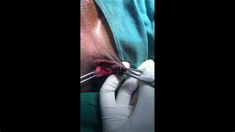 The index thrombosed external hemorrhoid was managed conservatively in 51.5 percent survival analysis for time to recurrence of thrombosed external hemorrhoid indicated that time to. Thrombosed Piles | Piles treatment with laser | Piles treatment in chennai - YouTube