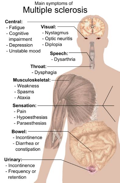 In verschiedenen regionen im gehirn wird die isolation der nervenfasern abgebaut und die nervenleitgeschwindigkeit herabgesetzt. Multiple Sklerose (Encephalitis disseminata)