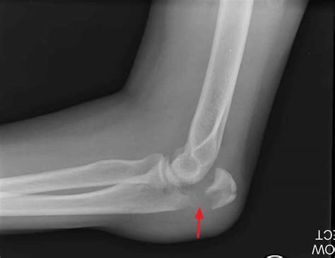 Of or pertaining to the bony tip of the elbow. Olecranon fracture causes, symptoms, diagnosis, treatment ...