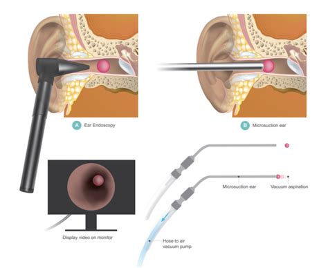 Earwax is normal, but if it's painful or uncomfortable professional help might be needed. Microsuction Ear Wax Removal at Cheshire Lasers, Middlewich.