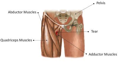 The adductor magnus, adductor brevis, adductor longus, the gracilis, and the pectineus. Fast natural cure for groin strain - huge relief in 24 hrs ...