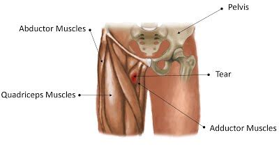 Groin strains are among the most common type of muscle strain, but they can be particularly annoying due to their location. Fast natural cure for groin strain - huge relief in 24 hrs ...