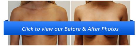 Biggest & most modern plastic surgery clinic in baltic states, team of 6 plastic surgeons Breast Implant Types Miami | Saline or Silicone Implants FL