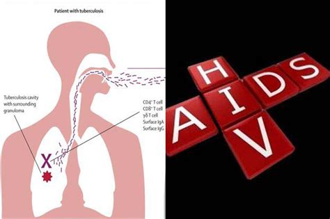 Nev — sari cizmeli mehmet aga. Mengapa Pasien TB Harus Tes HIV?