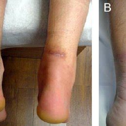 Simmonds' thompson test for achilles tendon rupture! (PDF) Clinical Outcomes and Complications of Percutaneous ...