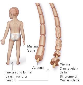 Parrillo je, dellinger rp, eds. Sindrome di Guillain-Barré