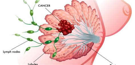 In some asymptomatic cases there is no evidence of a on your first visit to docrates, you are assigned a doctor of your own, while our coordinating nurse ensures that your treatment process is as smooth. A Lump Isn't the Only Symptom of Breast Cancer. Here Are 7 ...