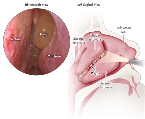 Polyps are an end result of varying disease processes in the nasal. Chronic Rhinosinusitis with Nasal Polyps | NEJM Resident 360