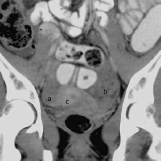 Ingesting asbestos fibers causes a chronic inflammatory immune response that leads to the. (PDF) Malignant Peritoneal Mesothelioma in a 16-Year-Old ...