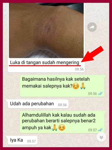 Obat yang terkenal yang digunakan dengan adanya peradangan dan supurasi pada tubuh. Review Pi Kang Wang Obat Jerawat Dan Gatal