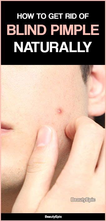 Severe and recurring blind pimple problem need to be treated by a. 13 Easy Ways to Get Rid of Blind Pimple Fast | Blind ...