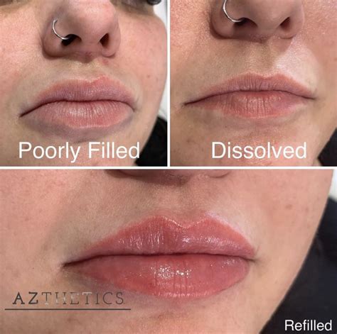 Check spelling or type a new query. Why are lip fillers so popular? | Azthetics Academy | Bristol