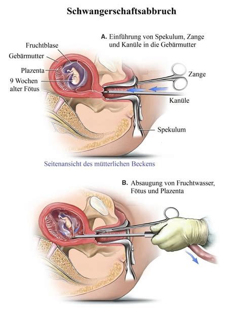 Es gibt situationen, in denen während einer schwangerschaft dadurch öffnet sich der muttermund frühzeitig, weil das wichtig: Schwangerschaftsabbruch, Medikament, Pille, Abtreibung ...