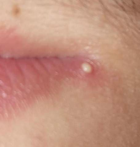 Je nach wachstum und wo sich die pickel an der lippe ansiedeln, kann es sogar zu beeinträchtigungen beim sprechen und essen kommen. Weiße Bläschen an der lippe? (Gesundheit, Medizin, Mund)
