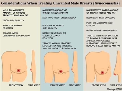 Research suggests that men are more likely to ignore breast lumps than women, but early diagnosis is key to getting the treatment you need to recover. Gynecomastia Zone - Blog