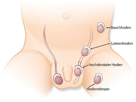 Nur hier kann ein baby wenn ihr baby ein lieblingsspielzeug hat, so halten sie es rechts oder links von ihrem kind, sodass es danach greifen will. Hodenhochstand - wann behandeln? | Baby und Familie