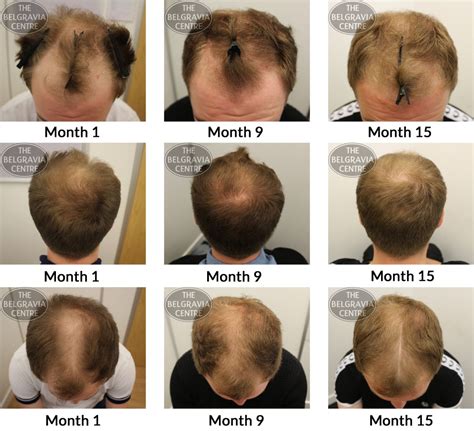 If you are worried about hair loss you can arrange a free consultation with a hair loss expert or complete our online consultation form from anywhere in the world. Belgravia Hair Loss Blog