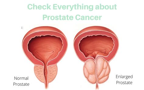Prostate cancer is the most common cancer among men. All you need to know about Prostate Cancer