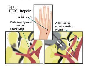 Partial excision of the triangular fibrocartilage complex articular disk: What is the TFCC? How do you Treat it? in 2020 | Athletic ...