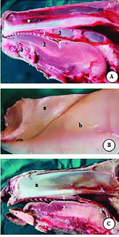 Nasal septal deviation (nsd) is a common diagnosis made by otolaryngologists but is one that is not usually based on objective measurements. A photograph of fresh specimens of nasal septum in buffalo ...