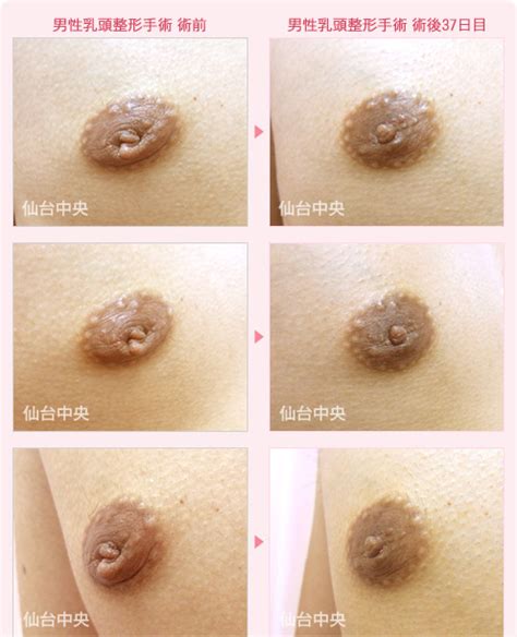 男性乳頭縮小・男性乳首整形/仙台中央クリニック