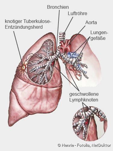 Who fact sheet on tuberculosis (tb): Tuberkulose (Tbc): Ansteckung, Symptome, Therapie - NetDoktor