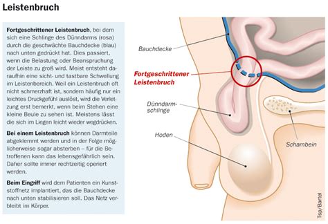 Hierbei handelt es sich um einen teil des bauchfells (), der im laufe der fetalentwicklung durch wanderung des sich in der bauchhöhle entwickelnden hodens in den hodensack durch den leistenkanal gestülpt wird. Leistenbruch symptome mann hoden - Die Einführung flirten